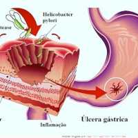 Úlceras - Causas, Sintomas e Tratamento