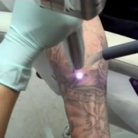 Técnica Para Remoção de Tatuagem