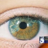TÃ©cnica Muda Cor dos Olhos Com Laser