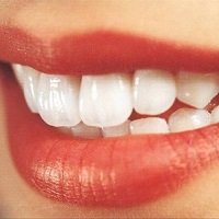Implante DentÃ¡rio: o que VocÃª Precisa Saber