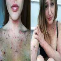 Mulher com Doença Rara Deixa Pedaços de Pele Onde Passa