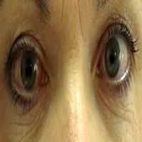 Glaucoma, Fatores de Risco